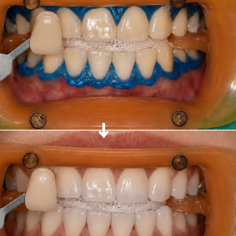 Some Discoloration Cannot Be Resolved with Whitening (Whitening vs. Veneers) image 3