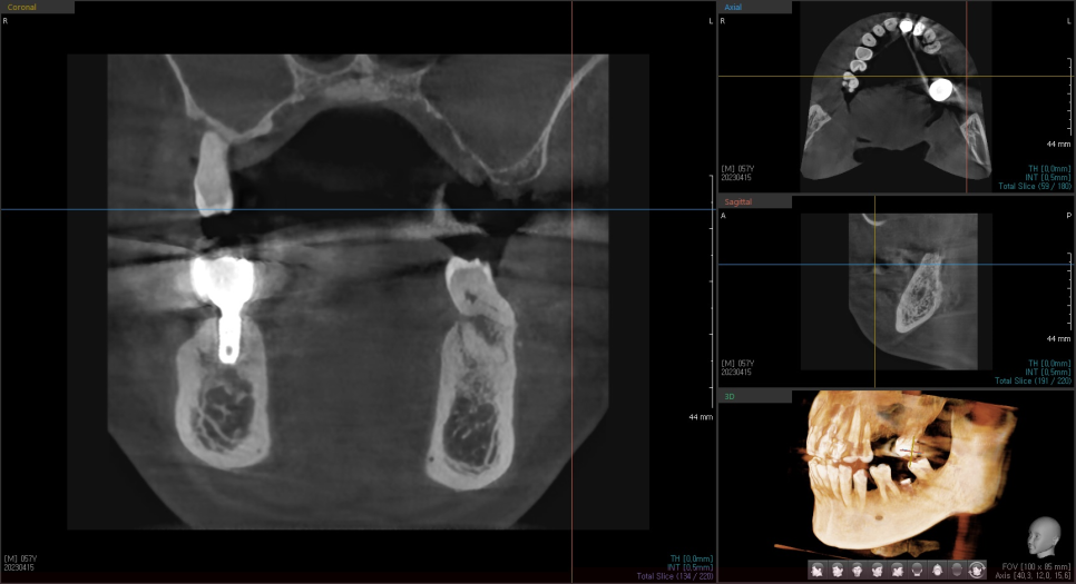 상일동 임플란트 상악동 거상술을 동반한 수술 증례 관련 이미지 3