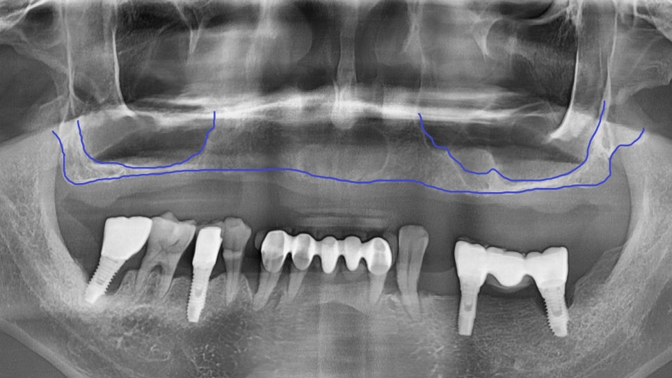 얇은 잇몸뼈, 임플란트 거부 당했다면? 상악동거상술로 해결할 수 있습니다. 관련 이미지 2