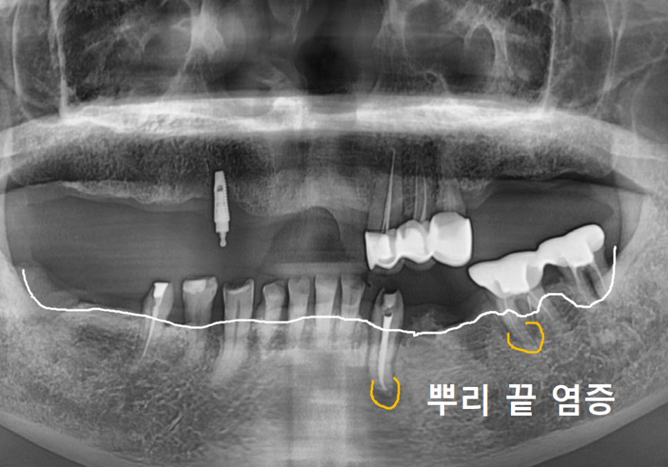 강동구 똑딱이 틀니, 정말 만능일까요? 식사할 때마다 들썩거리는 이유 관련 이미지 15