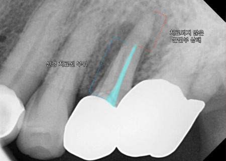 서울바르디치과 뿌리 끝 염증 심한 치아를 네비게이션 임플란트 #6 관련 이미지 4