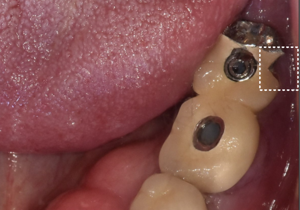 애써 심어둔 임플란트, 교체해야 된다구요? 냄새가 난다면 확인해보세요. 관련 이미지 4