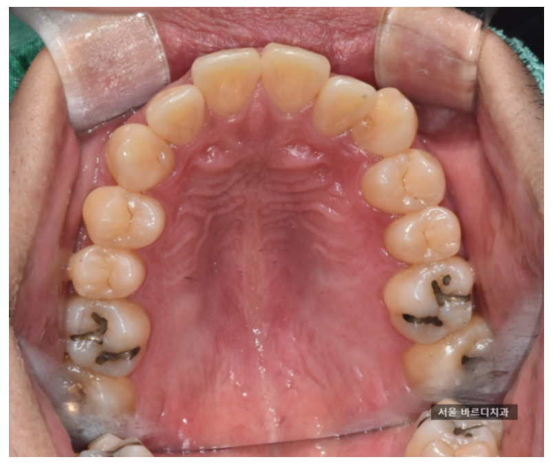 강남치과폐업 제발 호갱당하지마세요. 임플란트 잘하는곳은? 관련 이미지 4