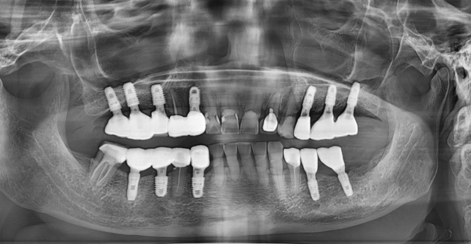 임플란트 사후관리 다른 병원 것도 수리 가능한 경우 정리해드립니다. 관련 이미지 6