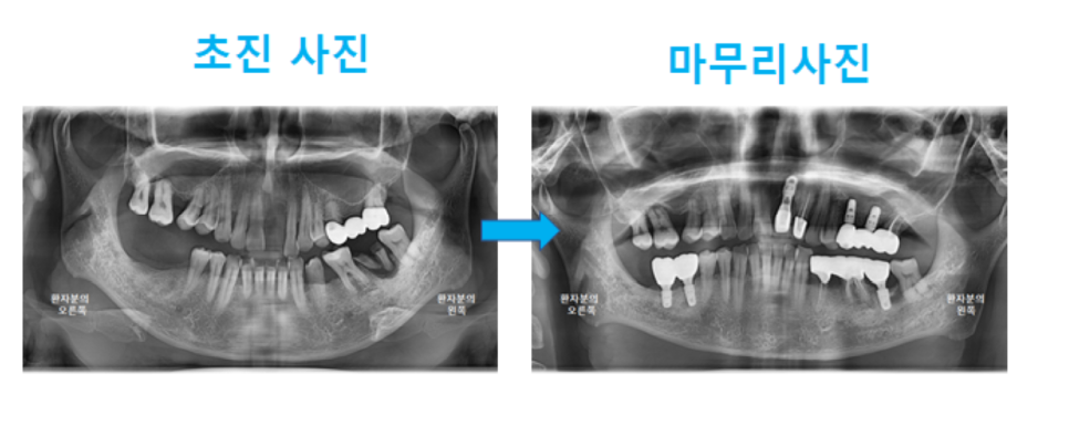 고덕동치과 서울바르디치과 전치부 및 구치부 임플란트 치료증례 #9 관련 이미지 39