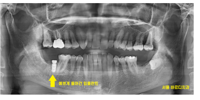 하남시청치과 내비게이션 임플란트 왜 좋다는거죠? 관련 이미지 7