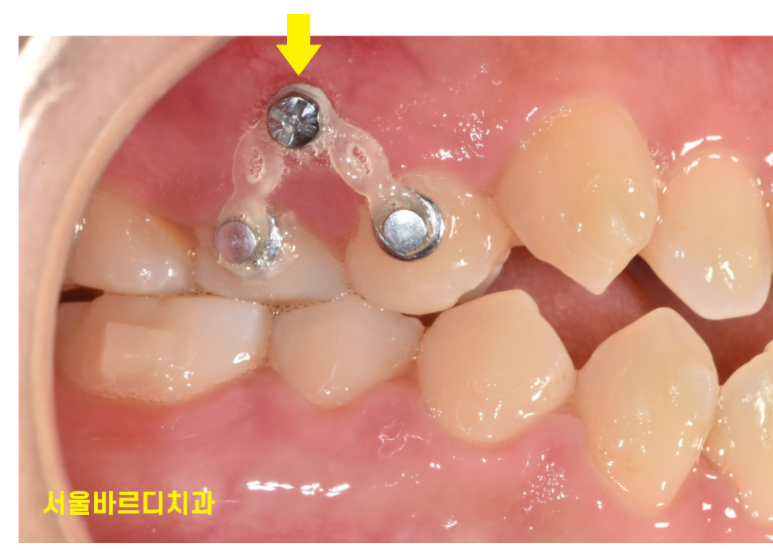 천호동 교정치과 치아교정 고무줄 왜 끼는건가요? 관련 이미지 2