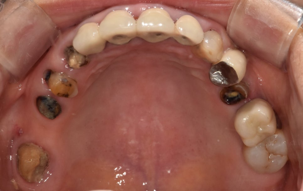 A Case of a 69-Year-Old Who Underwent Immediate Implant Placement After Extraction Due to Tooth Decay in Godeok-dong image 2