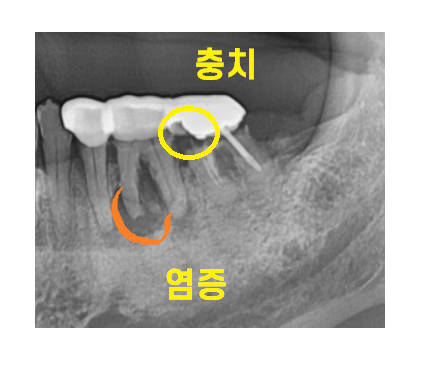 둔촌동 치과 80대 임플란트 가능한가요? 관련 이미지 6