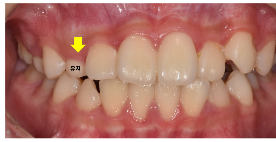Pediatric Orthodontic Treatment for Impacted Canines Is Needed to Guide Proper Eruption. image 3