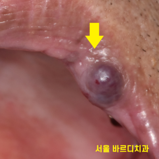 입술 혹 씹었을때 부풀고 딱딱 하다면 간단히 제거하세요 관련 이미지 7