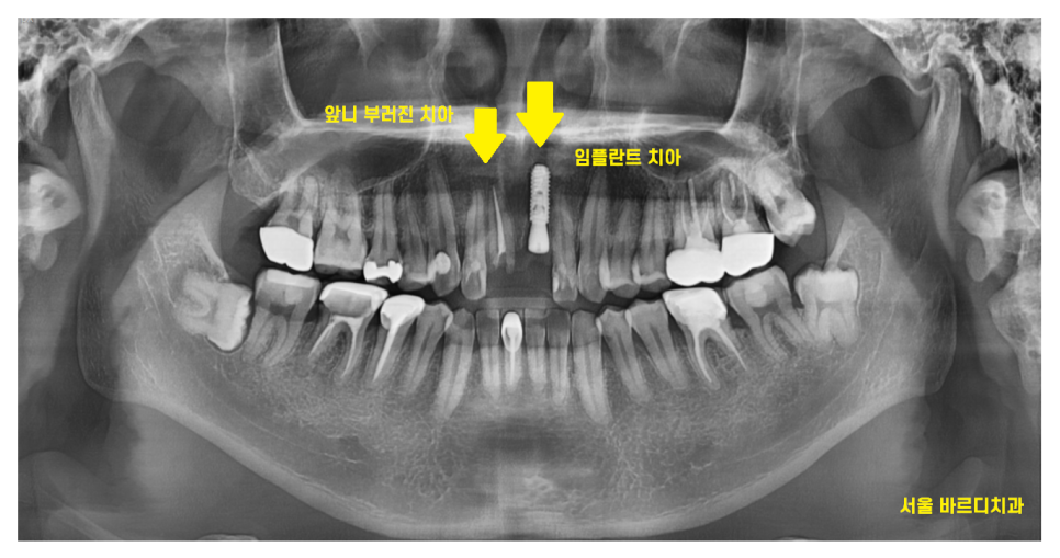 앞니 부러짐 손상이 커서 하남선동치과에서 임플란트 치료 관련 이미지 7