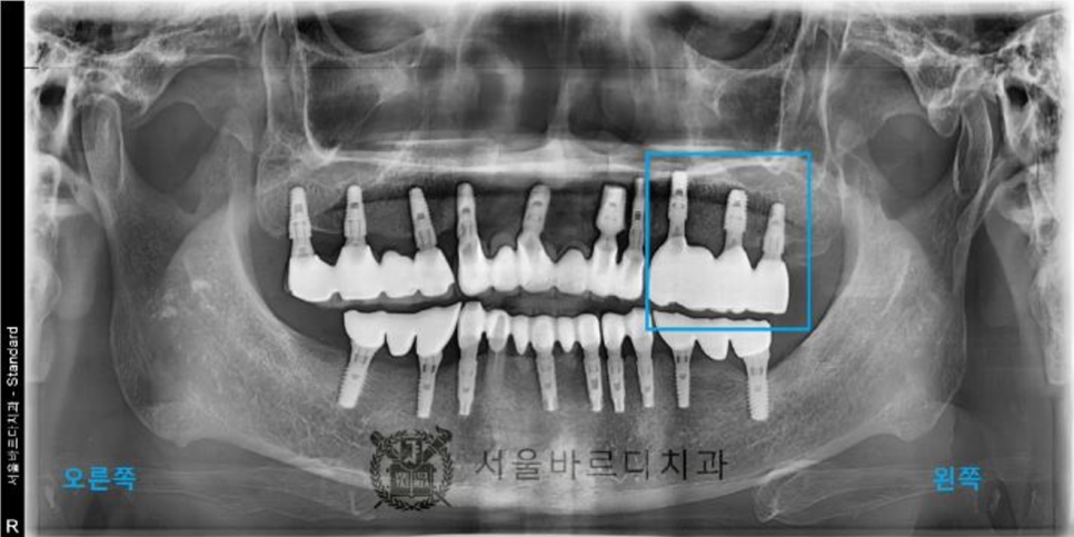 상일동역치과 서울바르디치과 무절개 네비게이션 임플란트 치료증례 #5 관련 이미지 17