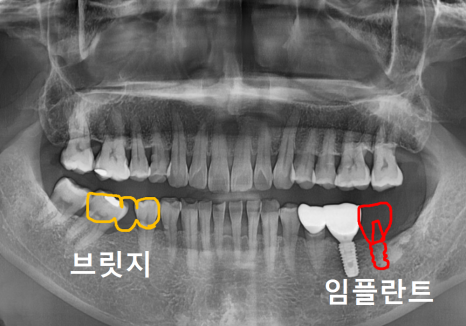 발치 후 빈 공간, 이 빼고 오래 냅두면 이렇게 됩니다. 관련 이미지 10