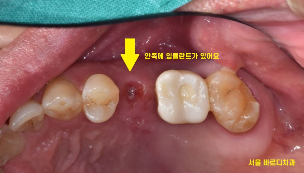 길동 치과 임플란트 보철 흔들림 교체 해야할 경우 관련 이미지 4