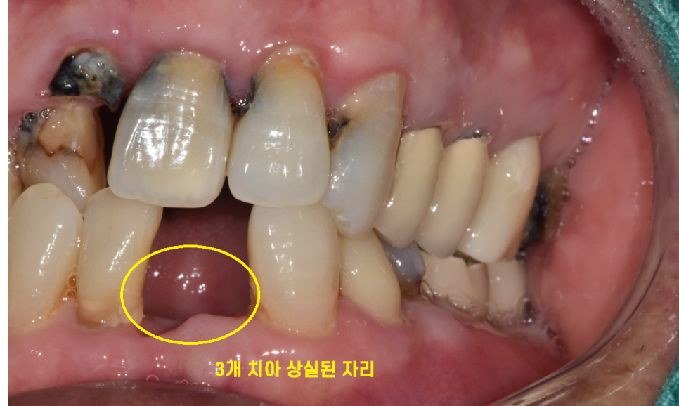길동 치과 임플란트 수술 대안은 없을까요???? 관련 이미지 6