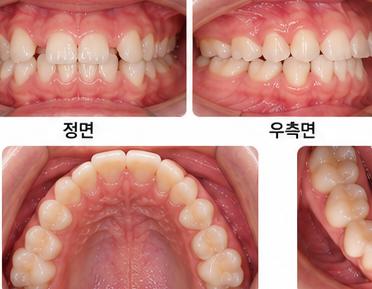 아이 덧니, 지금 교정해야 하나요? 아니면 더 기다릴까요? 교정 시점 관련 이미지 5