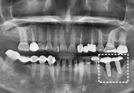 애써 심어둔 임플란트, 교체해야 된다구요? 냄새가 난다면 확인해보세요. 관련 이미지 12