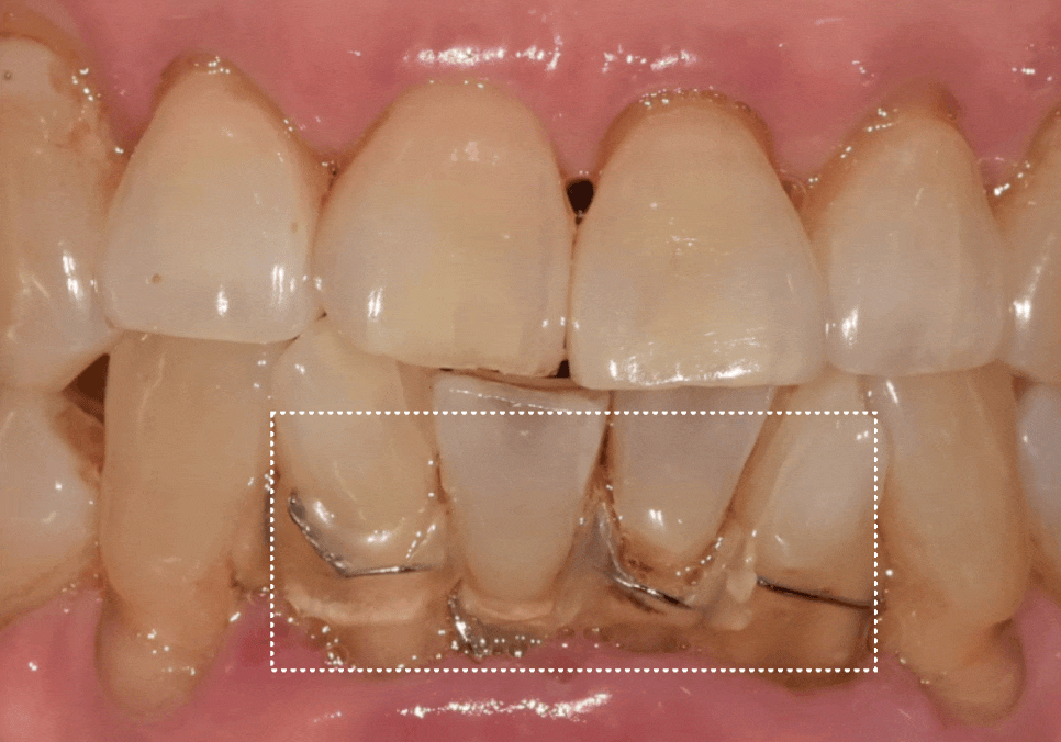 흔들리는 치아 묶어두는 잠간고정술, 오히려 잇몸뼈를 녹일 수도 있다고요? 관련 이미지 6