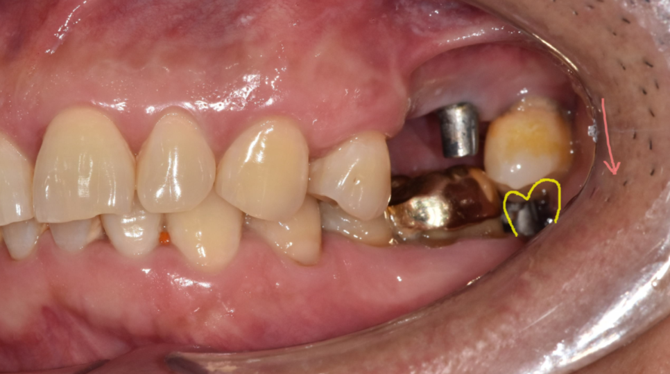 치아 상실 치료 치과 브릿지? 임플란트? 무엇이든 시도하세요. 관련 이미지 3