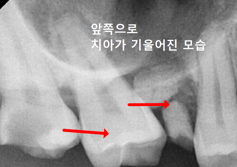 Myeongil-dong Implant Treatment in Your 20s: The Reason It Ended Up Requiring Bone Grafting After Thinking, “I’m Young, So It’ll Be Fine” image 3