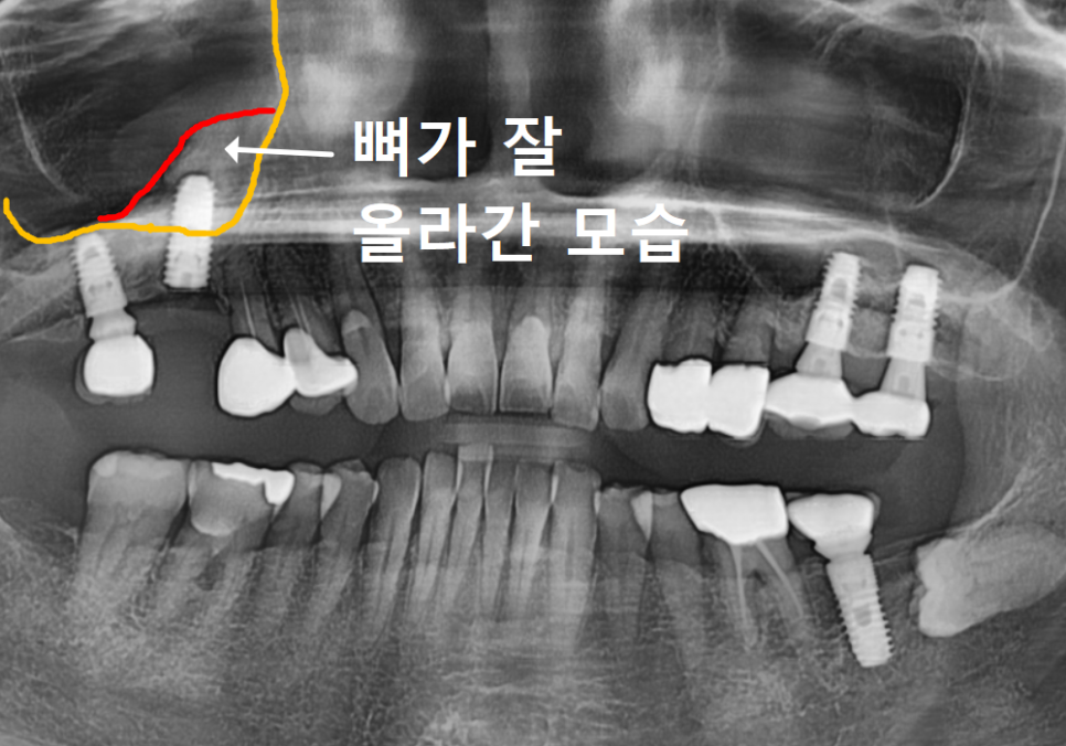 잇몸 고름 눌러보니 푹... 임플란트 주위염 방치했다가 재수술한 사례 관련 이미지 14