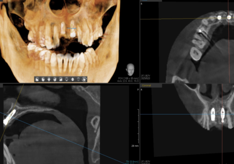 잇몸 까매짐 원인,증상,치료 방법 오래전에 앞니 씌운 곳 잇몸이 까매졌어요. 관련 이미지 10