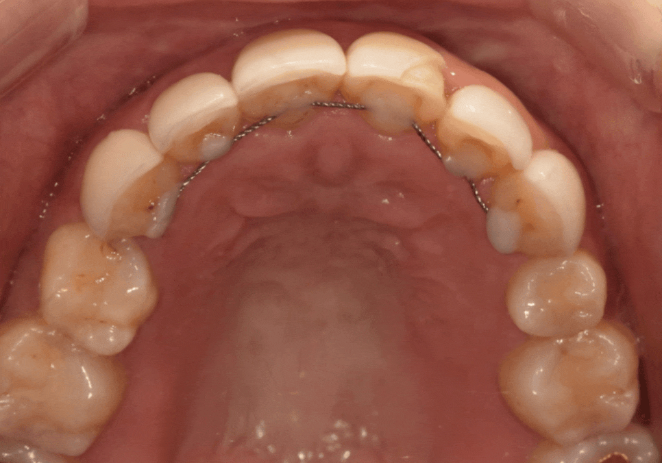 천호 라미네이트 파절 탈락, 줄이려면 치과 선택이 중요합니다. 관련 이미지 9