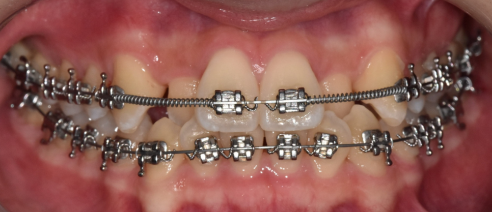 앞니 덧니 때문에 웃기 불편하다면? 상일동에서 치아교정 솔루션 관련 이미지 5