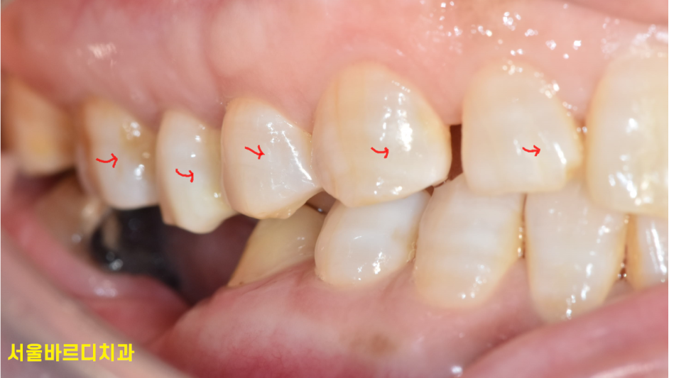 고덕동 교정치과 앞니 사이 틈 부분교정으로 치아 삭제없이 공간 없애기 관련 이미지 4