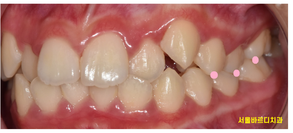 강동구 교정치과 교정 꼭 해야하나요??? 관련 이미지 2