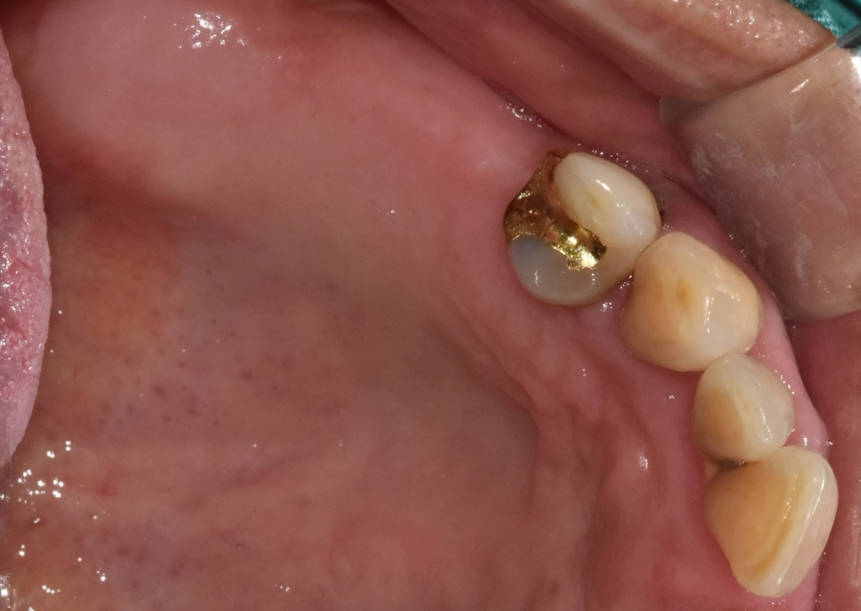 오늘 임플란트 심고, 내일 씹는게 가능하다고요?? (잔존골은 정답을 알고있다) 관련 이미지 1