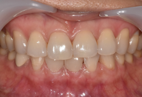 앞니 레진 떨어짐, 자꾸 반복된다면 관련 이미지 11