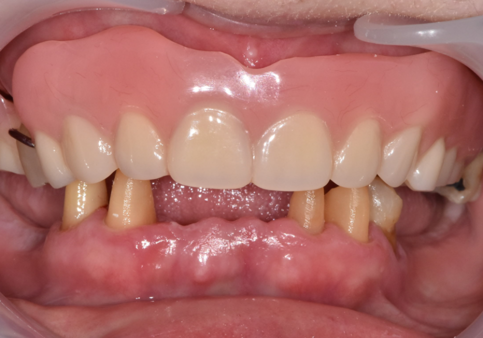 뿌리만 남은 치아, 그대로 두면 왜 위험할까요? 고덕동 전체 임플란트 재건 사례 관련 이미지 11
