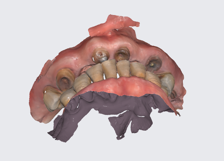 고덕역 치과 위아래 전체 임플란트 디지털을 사용하는 이유? 관련 이미지 4