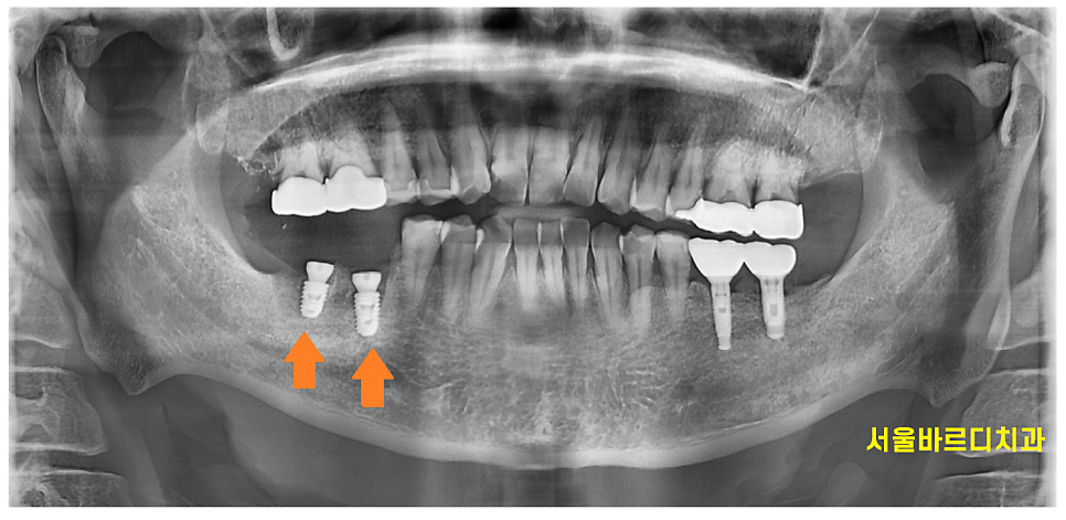 치아뿌리 염증 통증 유무 상관없이 치료를 받아야하는 이유 관련 이미지 7