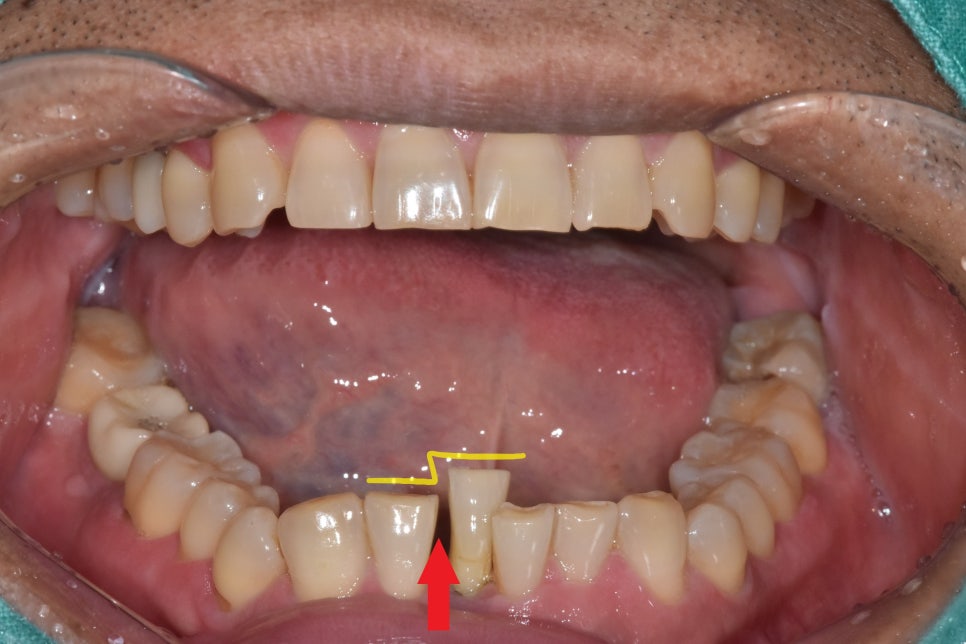 My Teeth Are Shaking So Much That Eating Is Uncomfortable—Is It Okay to Just Leave Them Alone? image 4