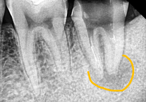 어금니 염증, 자연치 살리기에 진심인 저는 이렇게 살렸습니다. 관련 이미지 10