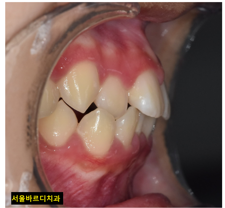 입툭튀 교정 돌출입 수술 없이 가능할까? 관련 이미지 1