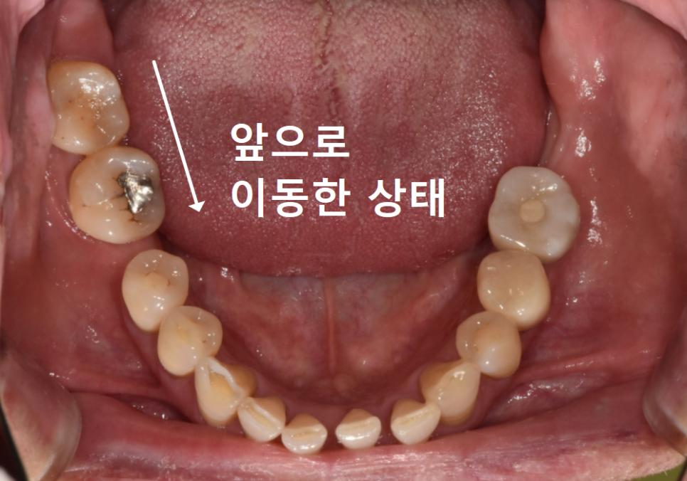 발치 후 빈 공간, 이 빼고 오래 냅두면 이렇게 됩니다. 관련 이미지 6