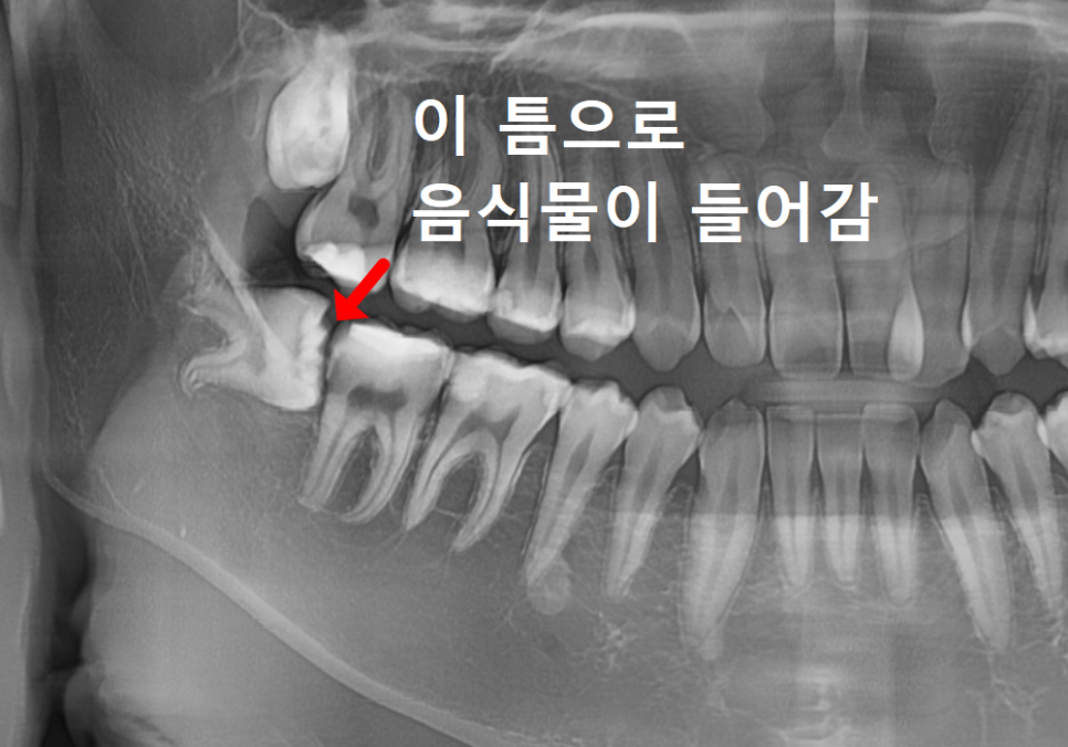 고덕동 사랑니 매복 발치, 안 아픈데 꼭 빼야 하나요? 관련 이미지 3