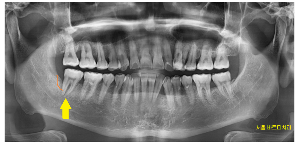 덕풍동 치과 잇몸 욱신 욱신 원인 찾아 임플란트 수술하였습니다. 관련 이미지 5