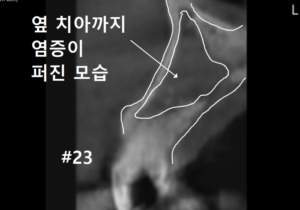 강동구 재신경치료, 왜 첫 치료보다 성공률이 낮다고 할까요? 관련 이미지 6