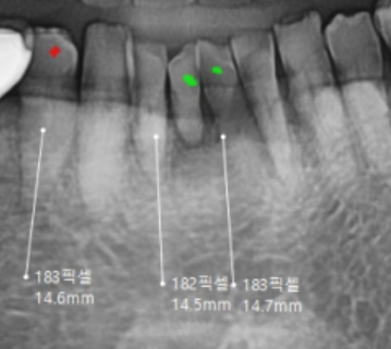 Restored 3 Teeth with Implants After Lower Front Teeth Became Loose and Fell Out image 4