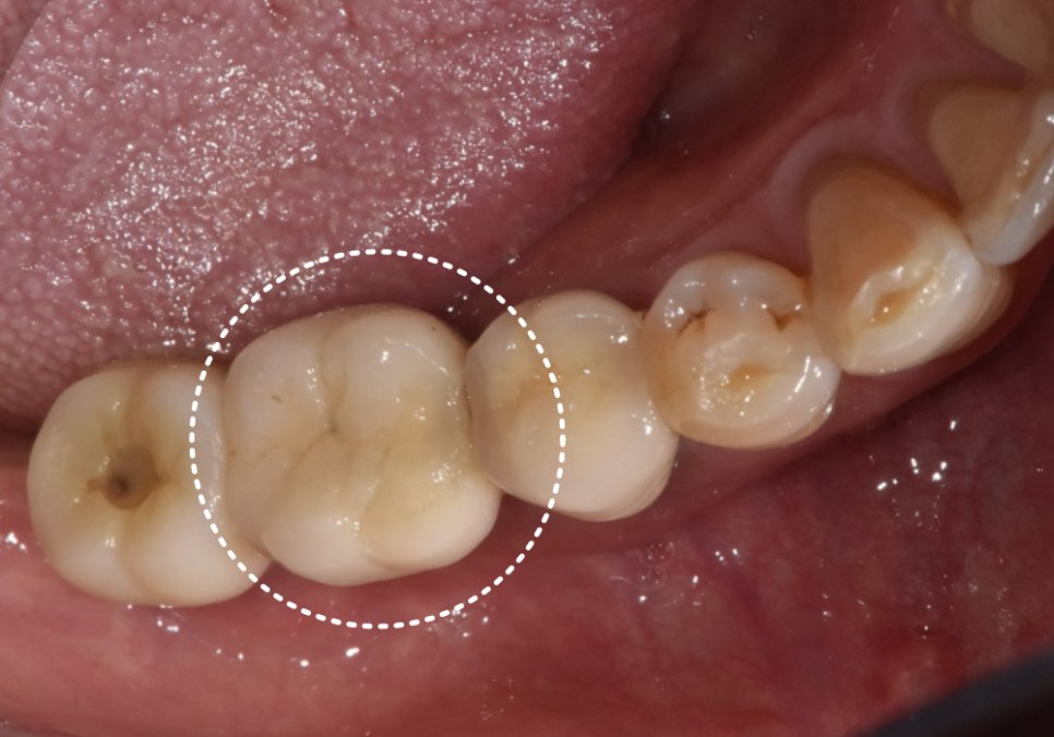 고덕 치과, 임플란트가 흔들려요. 뽑아야 할까 봐 고민이라면? 이렇게 해결합니다. 관련 이미지 1