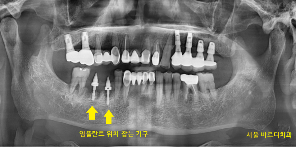 명일역 치과 움직이는 치아 치료 고정할 수 있을까? 관련 이미지 5