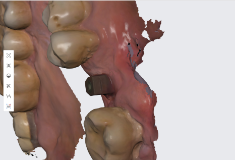 서울바르디치과 상하악 대구치 네비게이션 임플란트 치료증례 #4 관련 이미지 18