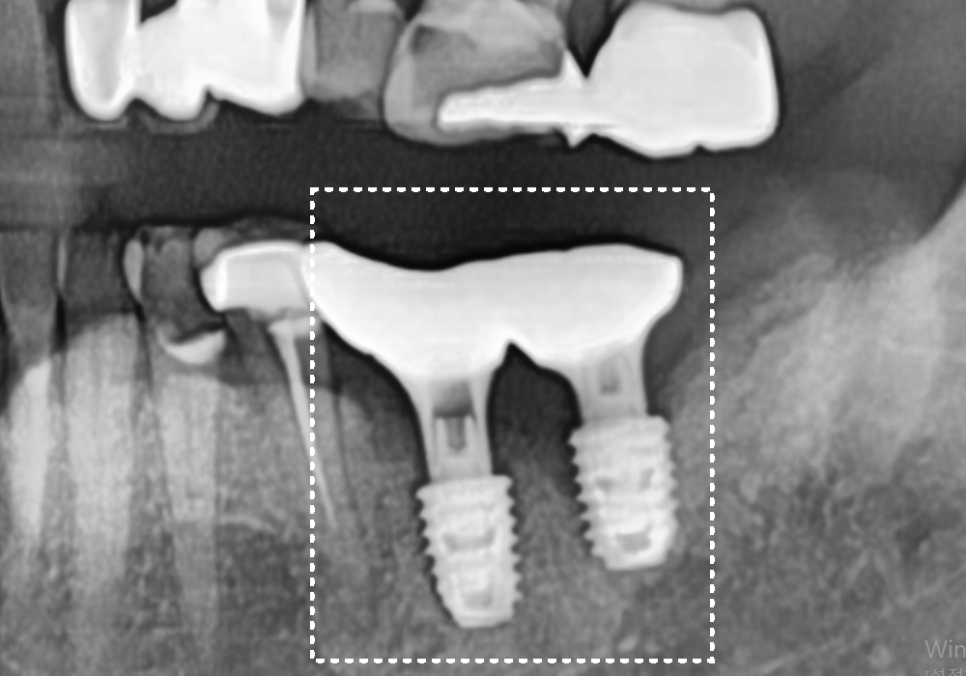 애써 심어둔 임플란트, 교체해야 된다구요? 냄새가 난다면 확인해보세요. 관련 이미지 14