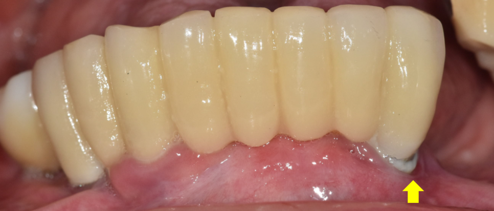 고덕동치과 임플란트 악취 냄새가 나는 이유는? 관련 이미지 7