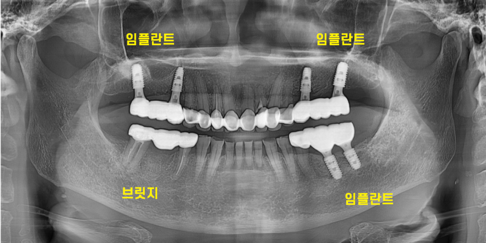 하남 임플란트 치과 주문진에서부터 치료 받으러 오신 환자분 관련 이미지 10